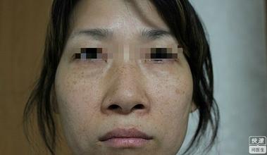 黄褐斑形成病因分析
